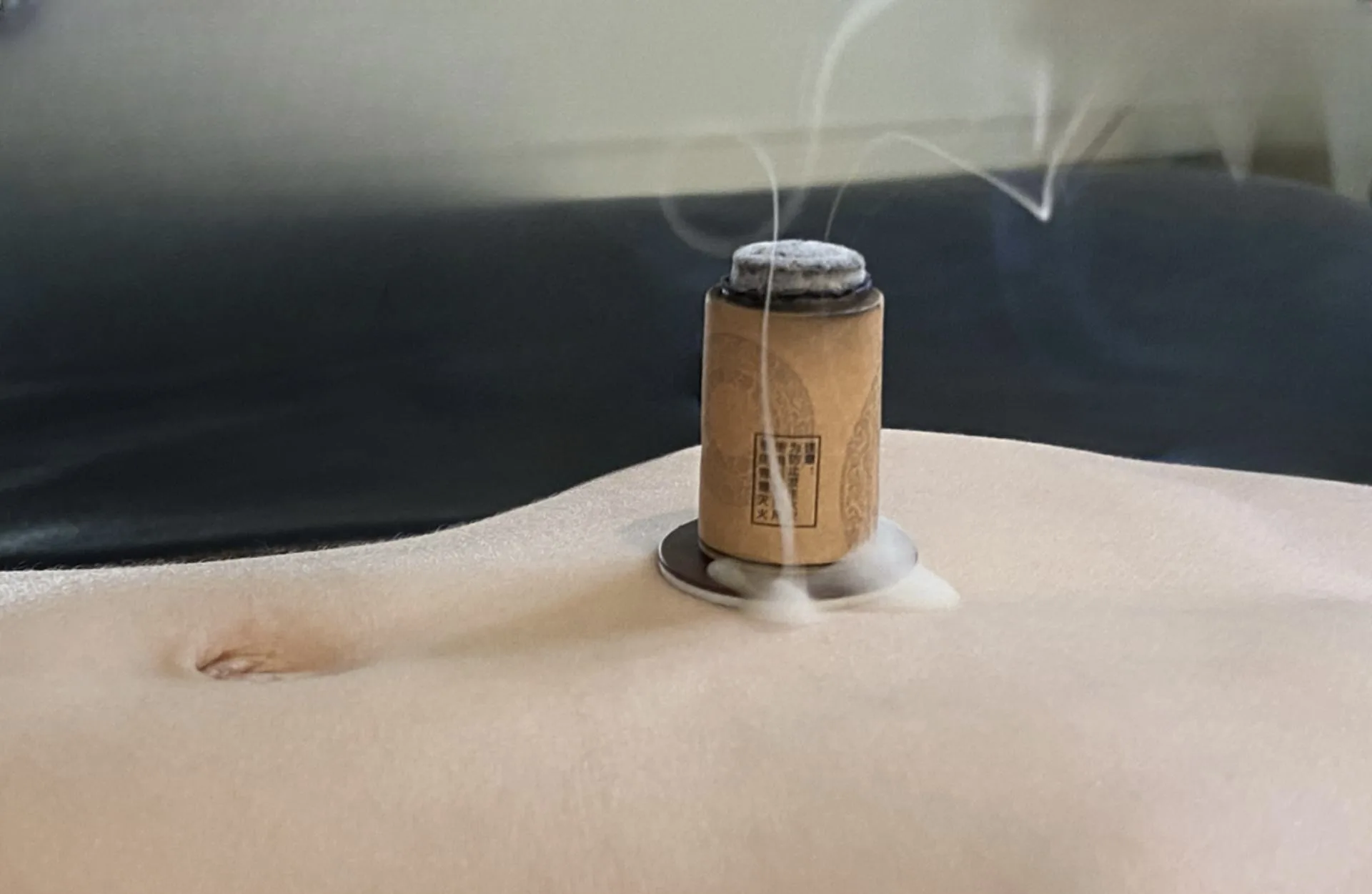 Moxibustion treatment — a lit moxa tube on a padded stand warming a patient's abdomen, smoke drifting upward